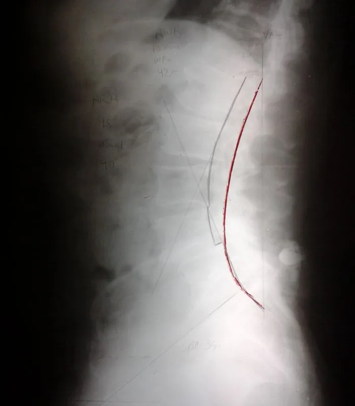 X-ray of spine with red line marking measurement or surgical annotation
