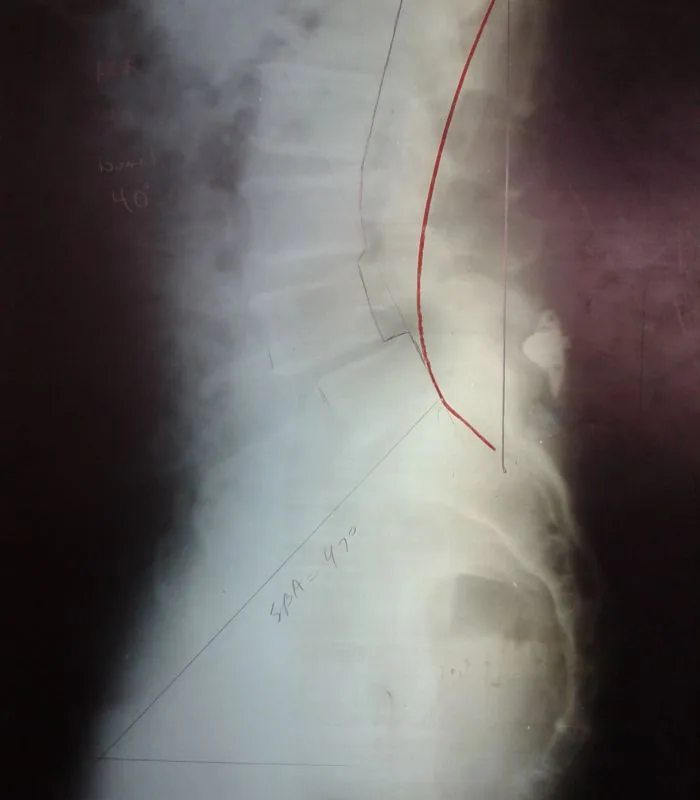 Medical X-ray image showing foot or ankle with red medical line and measurement markings