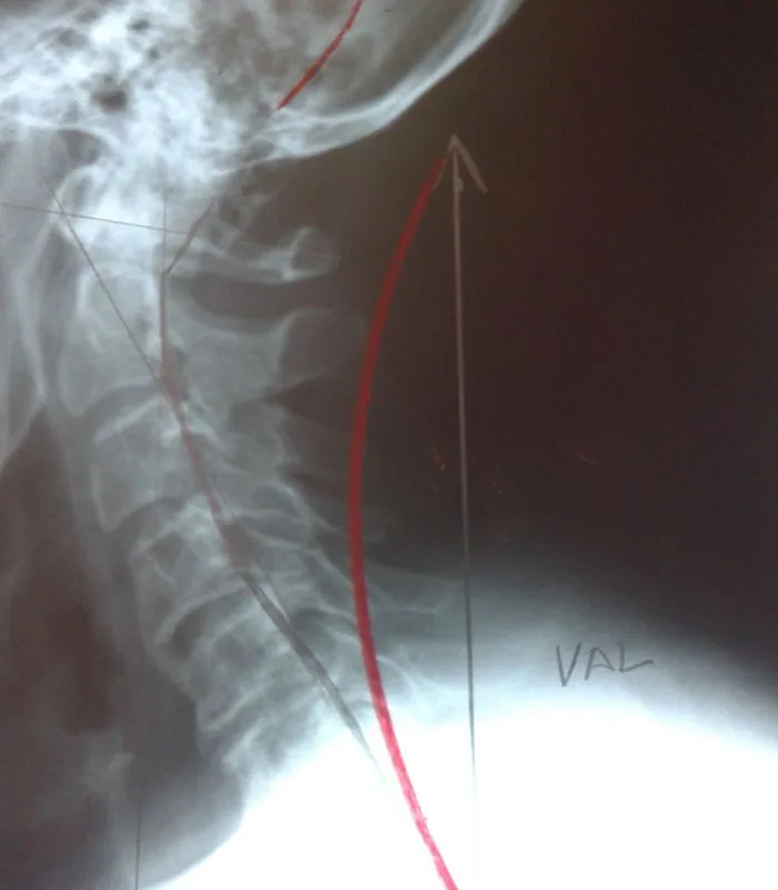 Cervical spine X-ray with measurement lines and VAL annotation showing vertebral alignment study