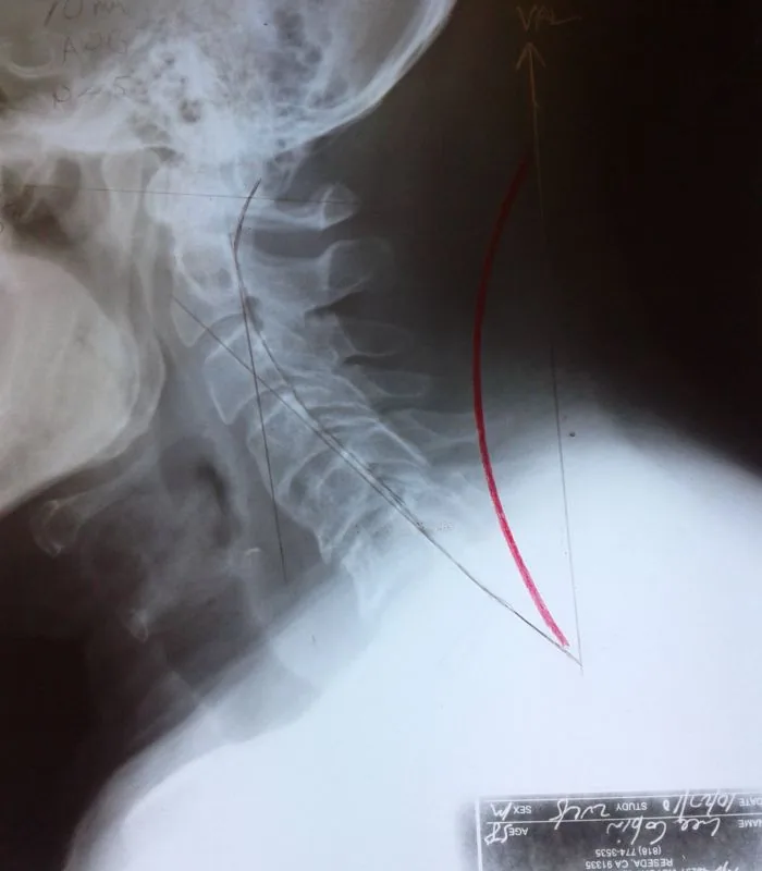 Cervical spine X-ray with medical catheter or guidewire visible in red overlay